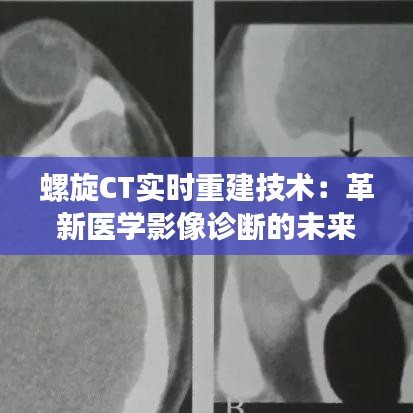 螺旋CT实时重建技术：革新医学影像诊断的未来