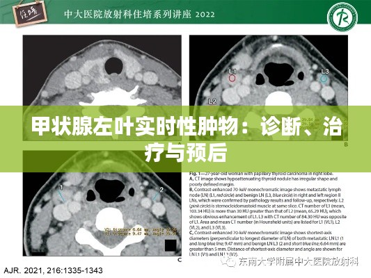 甲状腺左叶实时性肿物：诊断、治疗与预后