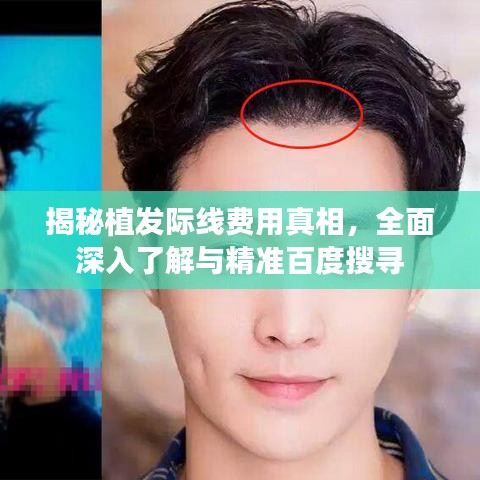 揭秘植发际线费用真相，全面深入了解与精准百度搜寻